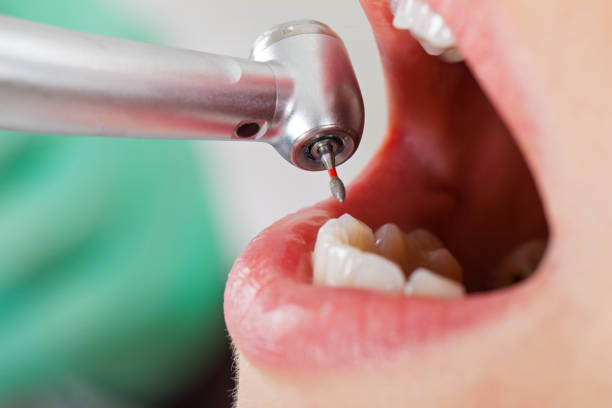 Best Broken or Chipped Tooth Repair in Harrisville, WV